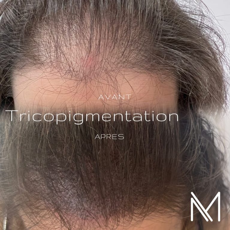 Tricopigmentation_4_hjtzbo