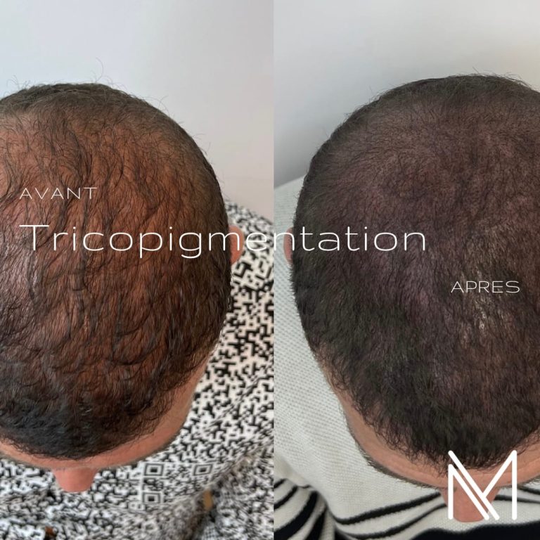 Tricopigmentation_5_eckpj7